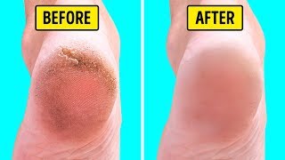 10 Natural Home Remedies for Silky Smooth Feet [upl. by Eolhc386]