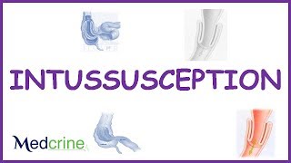 Intussusception  causes types  pathophysiologyfeaturesdx and treatment [upl. by Koeninger711]