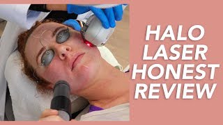 My Halo Laser Experience Honest Review Recovery and Before amp Afters [upl. by Adria]