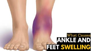 What Causes Ankles amp Feet Swelling  Diagnosis amp Treatment [upl. by Wildermuth]