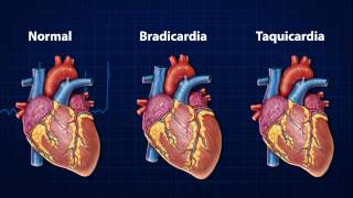Doenças do Coração  Arritmia Cardíaca [upl. by Liane]