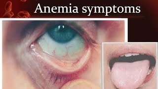 Anemia symptoms [upl. by Arras]