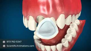 Dental Cap Procedure  Tooth Caps [upl. by Thatch697]