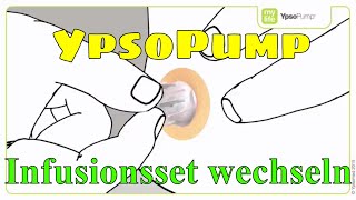 YpsoPump Infusionsset wechseln Insulinpumpe mylife Diabetescare 09 [upl. by Glynn]