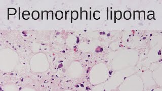 Pleomorphic Lipoma  Pathology mini tutorial [upl. by Alyahc]