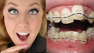 Braces Before And After  Timelapse Transformation  Ashley Craig [upl. by Ayanat]