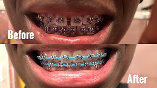 FULL BRACES JOURNEY 1 amp 12 YEARS GAPS SMALL OVERBITE CHAINS AND OVERALL EXPERIENCE [upl. by Hooge]