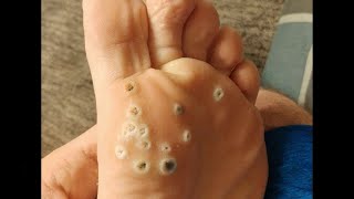 Plantar Wart Removal How to Remove Plantar Warts [upl. by Hannaj]