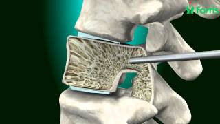 Orthopedic Spine Surgery vs Neurosurgery  Why I chose Spine Surgery [upl. by Sabba453]