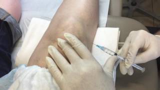 Lateral Retropatellar Injection of Euflexxa [upl. by Klemm]