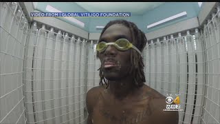 Doctor Says Vitiligo Can Be Treated [upl. by Angi151]