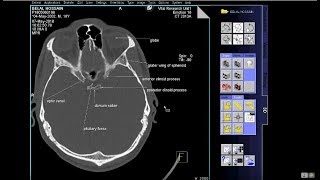 how to read ct scan of Skull bony window With Text [upl. by Gnaoh]