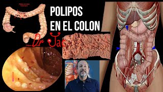 Pólipos en el colon [upl. by Sillig]