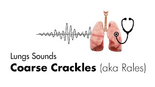 Coarse Crackles Rales  Lung Sounds  Medzcool [upl. by Ardnaz]