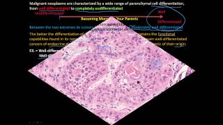 113P How to tell a benign and malignant tumor apart Differentiation and Anaplasia [upl. by Canning]