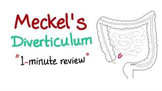 Meckels Diverticulum 1minute review [upl. by Poler713]