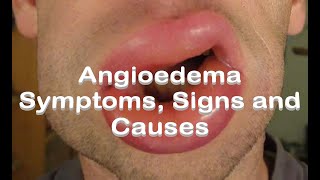 Angioedema  Symptoms Signs and Causes [upl. by Oakie]