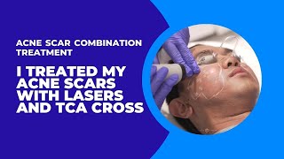 I TREATED MY ACNE SCARS WITH LASERS AND TCA CROSS  ACNE SCAR COMBINATION TREATMENT  Dr Jason Emer [upl. by Balthasar]