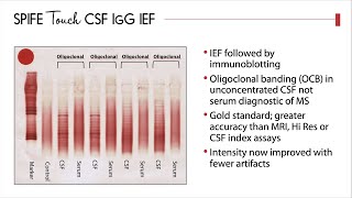 Oligoclonal Banding Assay Diagnosing Multiple Sclerosis [upl. by Pasquale]