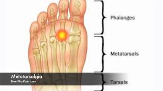 Metatarsalgia Foot Pain Causes Symptoms amp Treatments [upl. by Durgy]