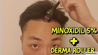 HOW TO USE DERMA ROLLER AND MINOXIDIL FOR HAIR GROWTH [upl. by Bunch]