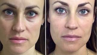 Dermal Filler Under Eyes Tear Trough [upl. by Baryram]