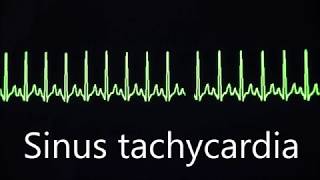 Cardiovascular System 8 Normal and abnormal heart rhythms [upl. by Ayadahs]