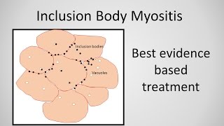 Inclusion Body Myositis Treatment [upl. by Minetta]