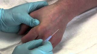 Intravenous Catheter Placement [upl. by Stillas401]