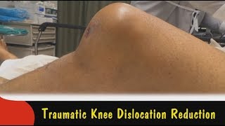 Traumatic Knee Dislocation Reduction [upl. by Elwina]