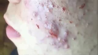 Amazing Blackhead Extraction [upl. by Christiansen110]