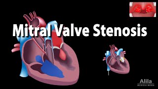 Mitral Valve Stenosis Animation [upl. by Timus]