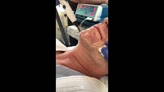 JPlasma Facial Resurfacing  Helium Plasma Radiofrequency  Live [upl. by Barbuto270]