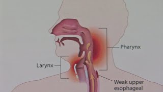 Laryngology 101 Vocal Cord Stripping [upl. by Anelehs9]