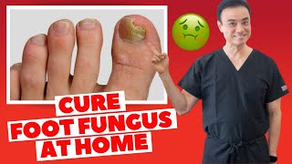 6 Effective HOME REMEDIES To CURE Toenail FUNGUS  Holistic Toenail Fungus Cures Part 2  Dr Kim [upl. by Nodnorb]