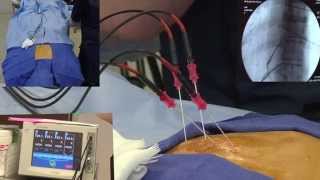 Radiofrequency Ablation Explanation Video Demonstration  LIVE [upl. by Davidson]