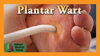 Causes of Plantar Fasciitis [upl. by Waine]