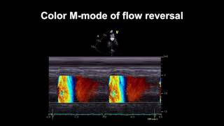 Echocardiography Essentials Detecting aortic regurgitation [upl. by Huff]