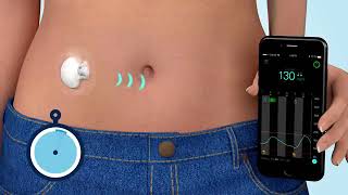 What is Continuous Glucose Monitoring CGM [upl. by Ennairrek459]