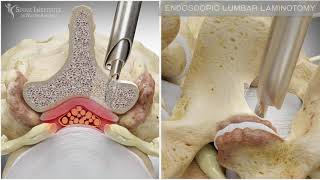 Endoscopic Lumbar Laminotomy  Spine Institute of North America [upl. by Garett315]