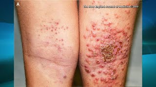 “Fungal Skin Infection of Many Colors” Tinea Versicolor  Pathogenesis Symptoms and Treatment [upl. by Lahcar]