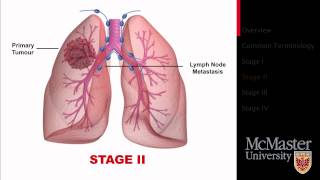 Algorithmic Approach to Multiple Lung Nodules [upl. by Ecarret782]