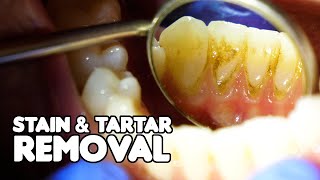 Dental Cleaning EXPLAINED  Stain amp Tartar Removal [upl. by Edbert]