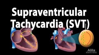 Supraventricular Tachycardia SVT PSVT Animation [upl. by Ardnikal303]