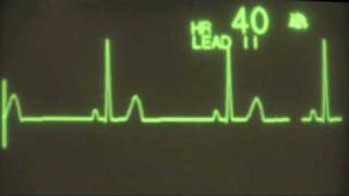 Sinus Bradycardia  ECG Training [upl. by Ergener835]