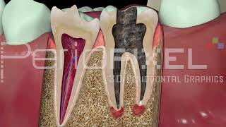 Vídeo 3D Endodoncia en Caries Profunda  PerioPixel [upl. by Rehnberg729]