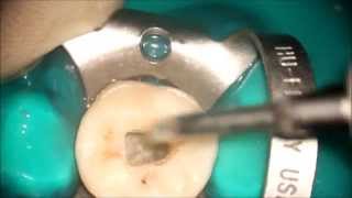 Second Mandibular Molar  Endodontic acces cavity [upl. by Parhe]