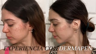 EXPERIENCIA CON DERMAPEN  Antes y después del tratamiento [upl. by Assillem]