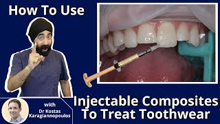 How to Use Injectable Composites To Treat Toothwear MASTERCLASS  PDP081 Injection Moulding [upl. by Yennep516]