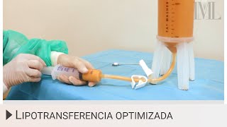 Lipotransferencia Optimizada Lipoinjerto de grasa autóloga [upl. by Cal]